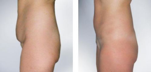 dolni miniabdominoplastika2