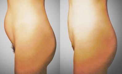 lipo pred1
