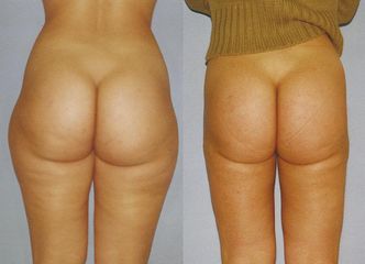 lipo pred3