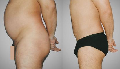 lipo pred