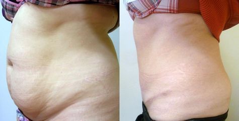 1413189982Abdominoplastika 2 pred