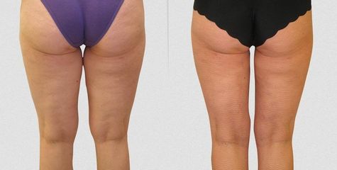1430826219lipo zezadu pred