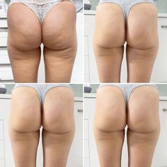 Celulitida EMTONE - MEDICOM Clinic