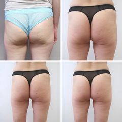 Emsculpt NEO - MEDICOM Clinic