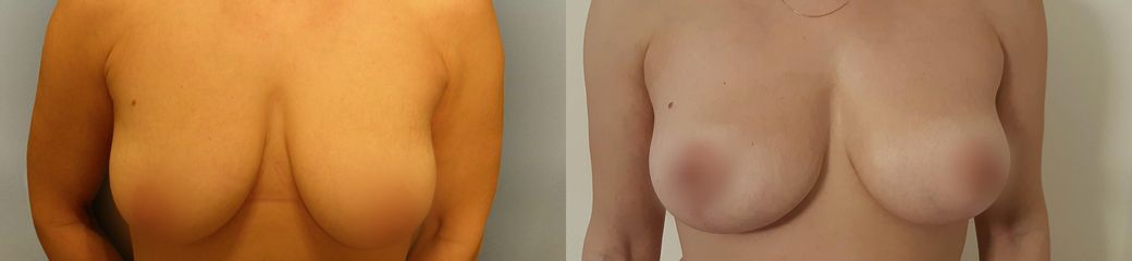 Modelace prsou - Ústav estetické medicíny Praha - Emauzy