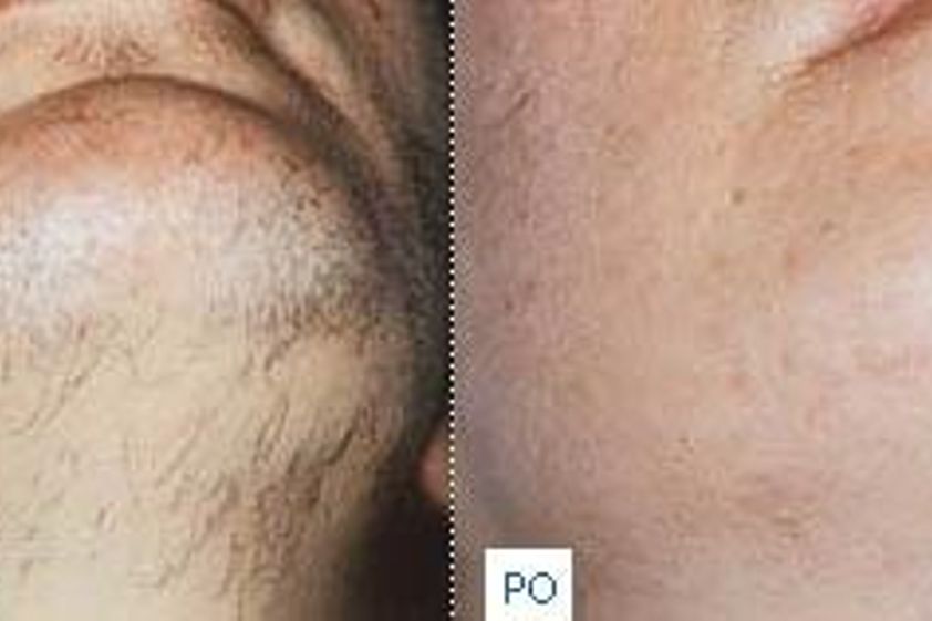Laserová epilace před a po - 723853