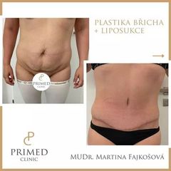 abdominoplastika MUDr. Martina Fajkošová