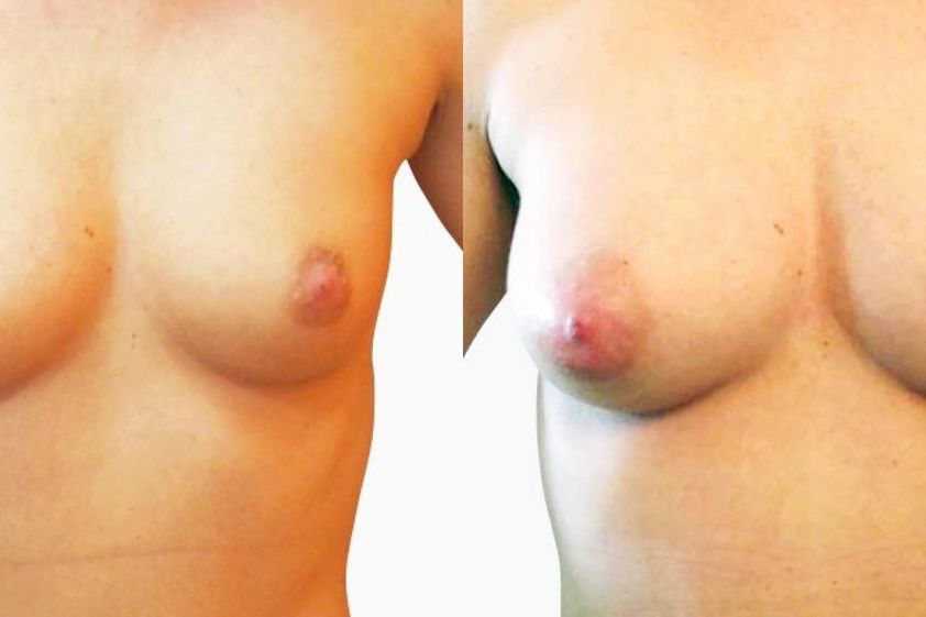 Lipofilling prsou před a po - 732358
