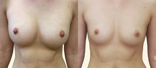 Lipotransfer do prsou