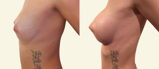 Augmentace prsou silikonovými implantáty