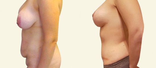 Abdominoplastika s liposukcí břicha a boků