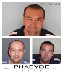 Transplantacia Vlasov Implantacia Vlasov pred po vysledky phaeyde p047