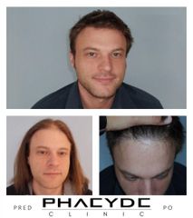 Transplantacia Vlasov Implantacia Vlasov pred po vysledky phaeyde p055