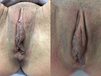 Laserová rejuvenace vagíny před a po - 727196