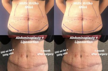 Abdominoplastika s liposukcí