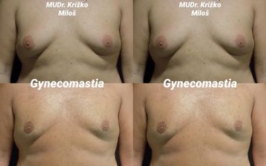 Gynekomastie