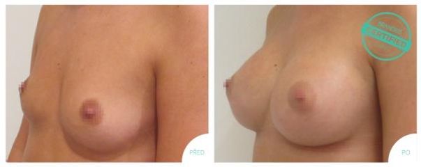 Zvětšení prsou pomocí anatomického implantátu