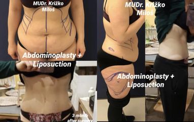Abdominoplastika s liposukcí