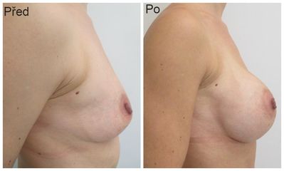 Zvetseni prsou pomoci implantatu