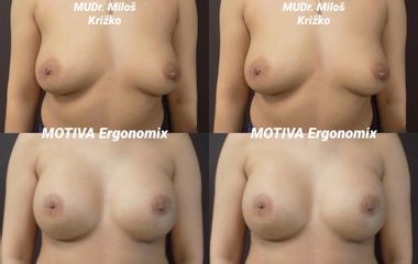 Augmentace MOTIVA Ergonomix