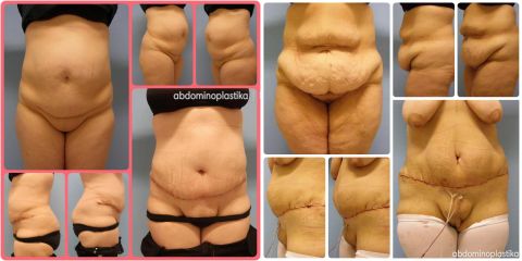 Abdominoplastika - MUDr. Michal SVITÁK