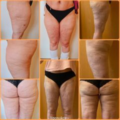 Liposukce - MUDr. Michal SVITÁK