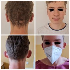 Otoplastika - MUDr. Michal Sviták
