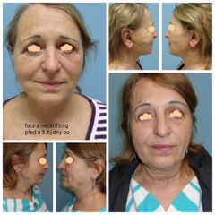Facelift - prim. MUDr. Michal Sviták