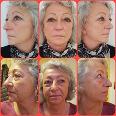 Facelift - prim. MUDr. Michal Sviták