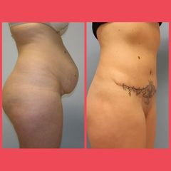 Abdominoplastika - prim. MUDr. Michal Sviták