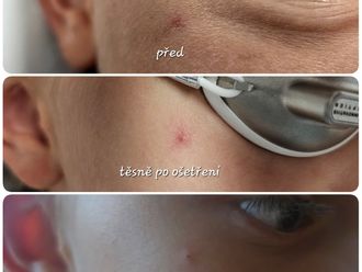 Laserové odstranění rozšířených žilek před a po - 861482