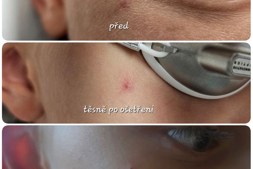 Laserové odstranění rozšířených žilek před a po - 861482