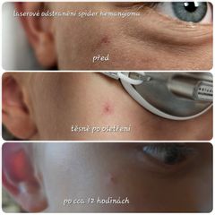 Laserové odstranění rozšířených žilek - prim. MUDr. Michal Sviták