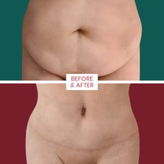 Abdominoplastika - ABClinic Art & Beauty