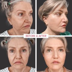 Facelift - ABClinic Art & Beauty