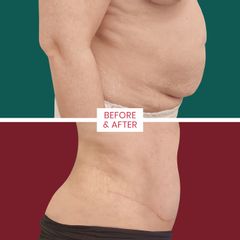 Abdominoplastika - ABClinic Art & Beauty