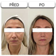 Endolift obličeje - MarBelle Clinic s.r.o. - MUDr. Martina Matzenauer