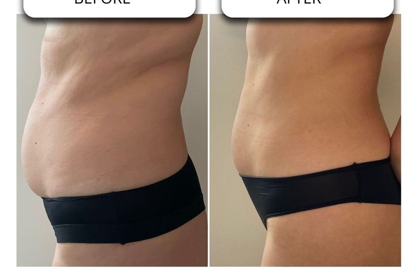 Neinvazivní liposukce před a po - 869210