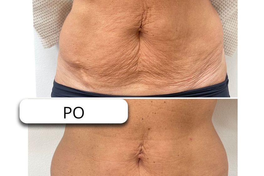 Neinvazivní liposukce před a po - 869211