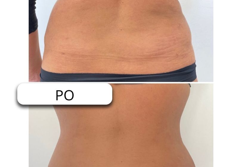 Neinvazivní liposukce před a po - 869213
