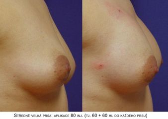 Zvětšení a modelace prsou – Metacrill