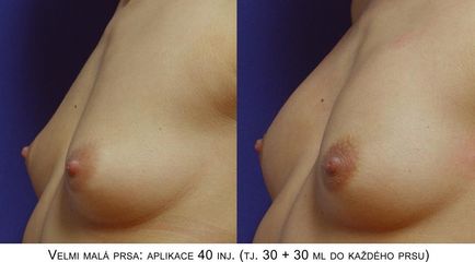 Zvětšení a modelace prsou – Metacrill