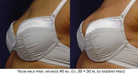 Zvětšení a modelace prsou – Metacrill