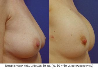 Zvětšení a modelace prsou – Metacrill