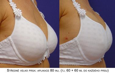 Zvětšení a modelace prsou – Metacrill