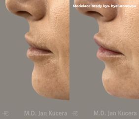 Kyselina hyaluronová - MUDr. Jan Kučera - Perfect Clinic Dermatology