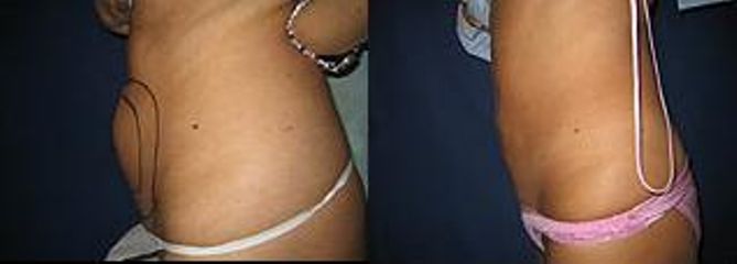 liposukcebrisni stenapred