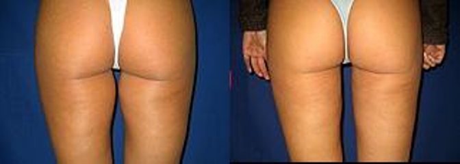 liposukcevnitrni cast stahenpred