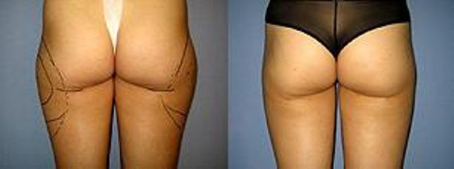 liposukcevnejsi cast stahenpred