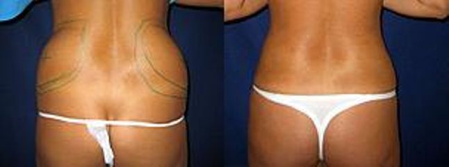 liposukceboky zenypred